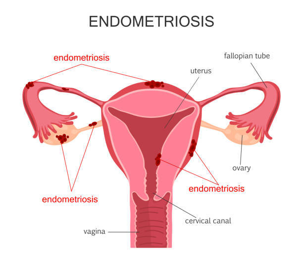 Endometriosis, una enfermdad de la que se habla poco